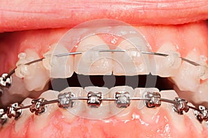 Teeth with metal and ceramic braces photo