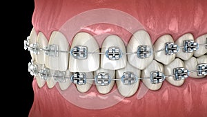 Teeth with metal and Clear braces in gums