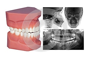 Teeth model and cephalometric x-ray isolated on withe photo