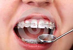 Teeth with orthodontic brackets.