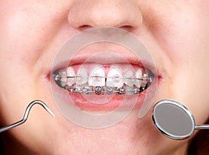 Teeth with orthodontic brackets.