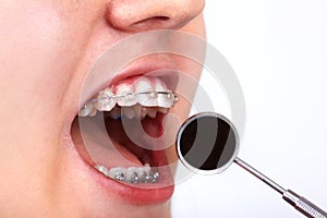 Teeth with orthodontic brackets.