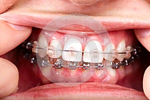 Teeth with orthodontic brackets.