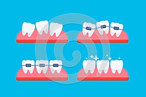 Teeth, orthodontic treatment. Braces on the teeth. Dental care health. Vector illustration