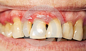 Teeth with periodontitis photo