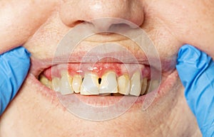 Teeth with periodontitis photo