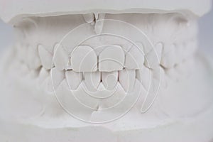 Teeth plaster cast