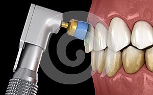 Teeth polishing procedure with professional brush and gel. Medically accurate