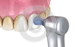 Teeth polishing procedure with professional brush and gel. Medically accurate 3D illustration