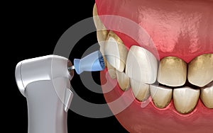 Teeth polishing procedure with professional brush and gel. Medically accurate 3D illustration