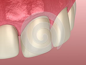 Teeth preparation for Veneer installation procedure over central incisor and lateral incisor. Medically accurate tooth