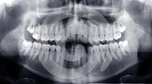 Teeth x-ray