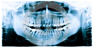 Teeth x-ray image