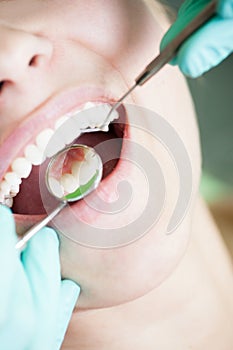 Teeth reflection on dentist mirror