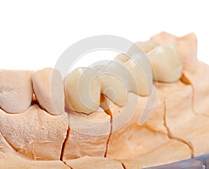 Teeth rehabilitation