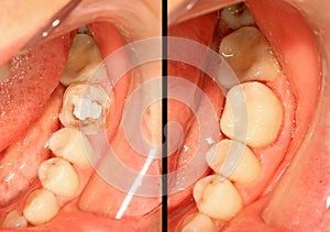 Teeth restoration photo