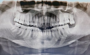 Teeth rontgen image