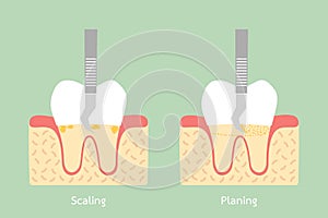 Teeth scaling - dental plaque removal, anatomy structure including the bone and gum