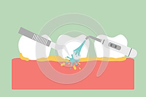 Teeth scaling, dental plaque removal for cleaning