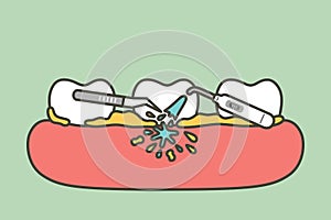 Teeth scaling, dental plaque removal for cleaning