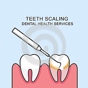 Teeth scaling icon - cleaning tooth with periodontal probe