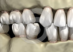 Teeth shift deformatiuon after losing teeth. 3D illustration of Popov Godon phenomenon