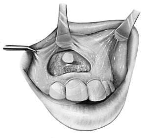 Teeth - Surgical Exposure of Impacted Incisor