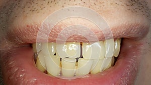 Teeth with tartar and caries, crooked lower foreground incisors, close-up