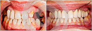 Teeth before and after treatment photo