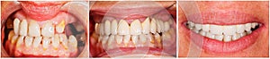 Teeth before and after treatment photo