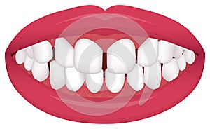 Teeth trouble  bite type / crooked teeth  vector illustration /Excessive Spacing