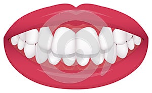 Teeth trouble  bite type / crooked teeth  vector illustration /Overbite Back teeth