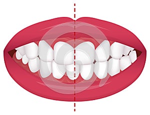 Teeth trouble  bite type / crooked teeth  vector illustration  /Crossbite misalignment photo