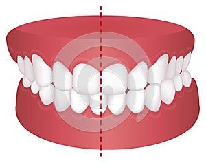 Teeth trouble  bite type  vector illustration / Crossbite misalignment