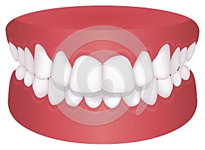 Teeth trouble  bite type  vector illustration //Overbite Back teeth