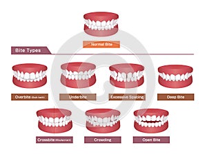 Teeth trouble  bite type  vector illustration set