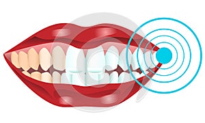 Teeth whitening