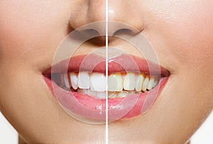 Teeth Before and After Whitening