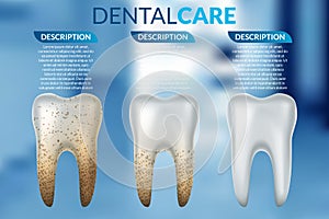 Teeth whitening 3d concept. Comparison of clean and dirty tooth before and after whitening treatment. Teeth whitening procedure,