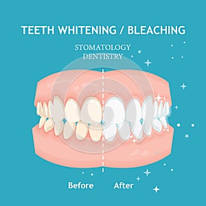 Teeth whitening and bleaching concept. Dentistry and stomatology vector photo