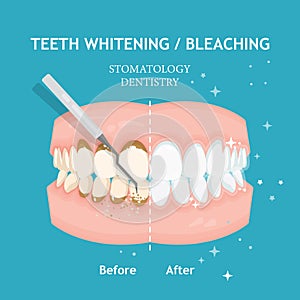 Teeth whitening and bleaching concept in flat style. Dentistry and stomatology vector