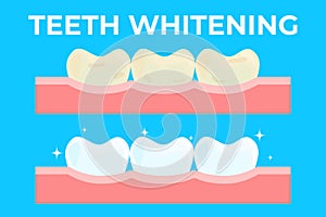 Teeth whitening or bleaching vector illustration. Concept of dental healthcare, stomatology care, professional tooth