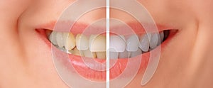 Teeth before and after whitening