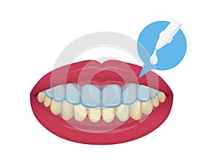 Teeth whitening at home vector illustration / no text