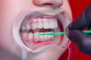 Teeth whitening procedure person whiten teeth in mouth expander