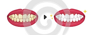 Teeth whitening vector illustration / before and after No text