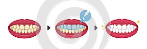 Teeth whitening vector illustration / before and after No text