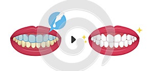 Teeth whitening vector illustration / before and after No text