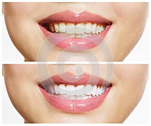 Zuby pred a po bieliaci prostriedok 