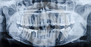 Teeth x-ray